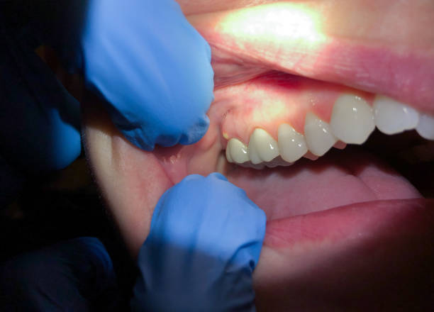 Best Emergency Treatment for Toothache in Plantsville, CT